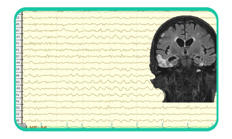 EEG encefalita